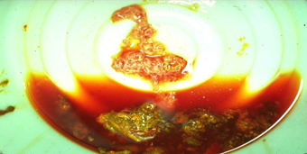 Characteristic dysenteric stool of a patient with shigellosis, containing blood, mucus and small amounts: of fecal matter. Photograph courtesy of Michael L Bennish and M. John Albert from the chapter “Shigellosis” in the Book.